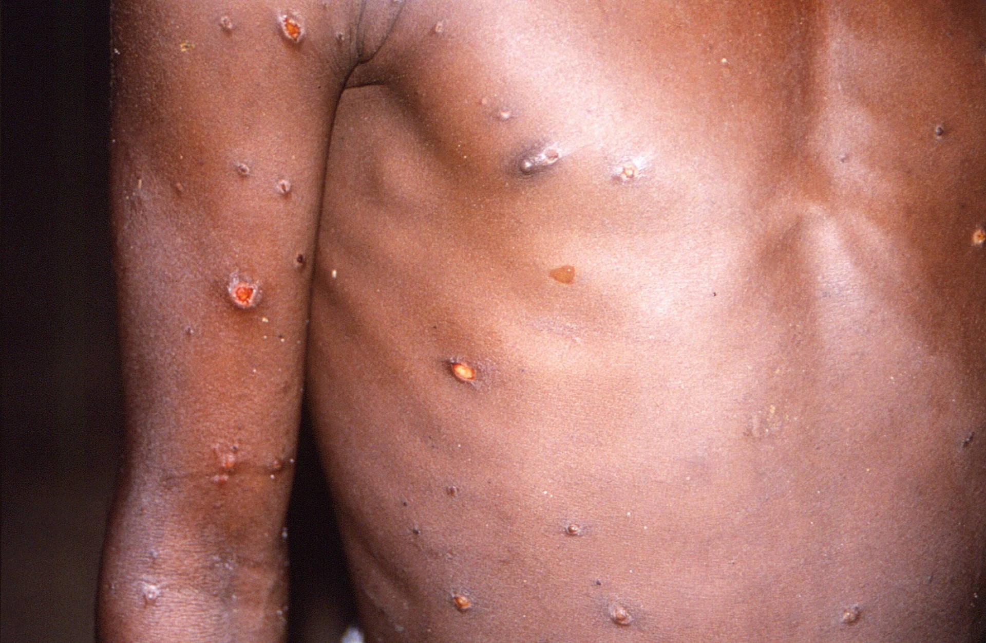 majmunske-boginje-monkeypox-reuters.jpg