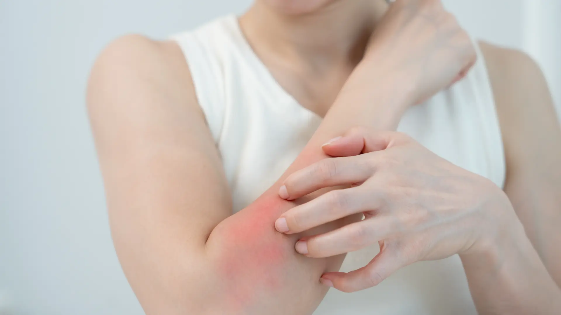 shutterstock_2666457223 koža crvenilo ruka kožno oboljenje lopra dermatologija dermatolog-694013c117d27.webp