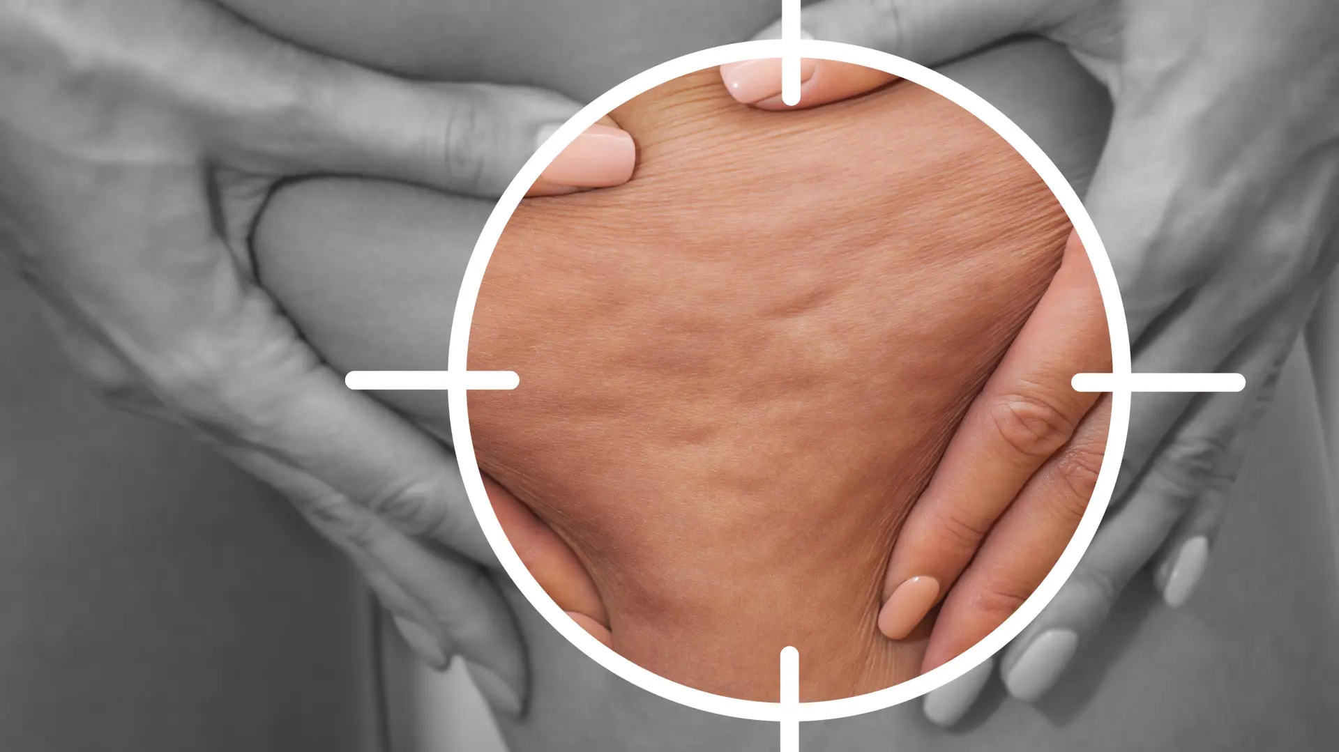 shutterstock_2298182349 masti celulit debljina mršavljenje-697347356f880.webp