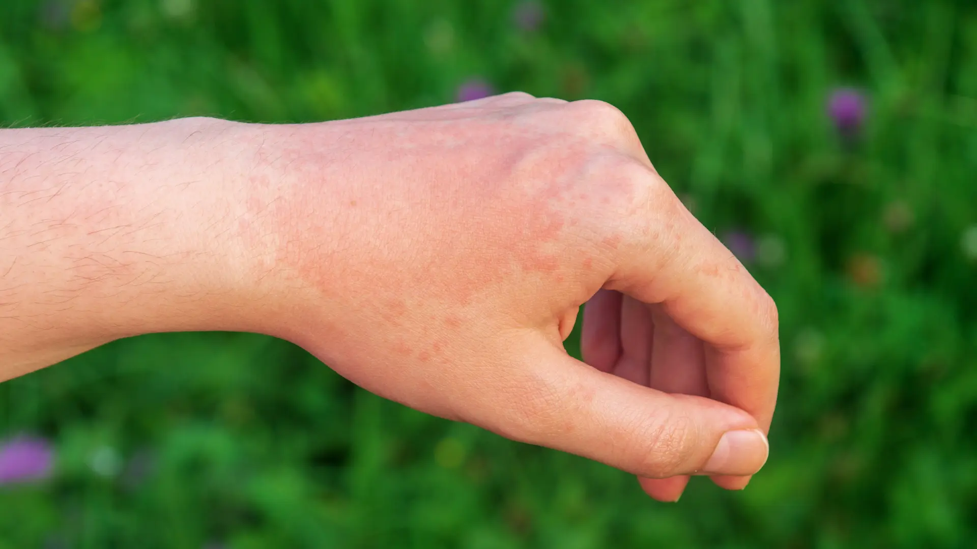 shutterstock_2019554561 crvenilo koža alergija na sunce-69da712d3eb7a.webp