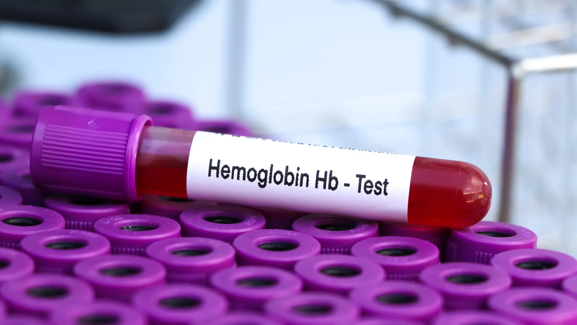 shutterstock_2234772017 hemoglobin test krvna slika krv-69fdbeef6f7d0.webp