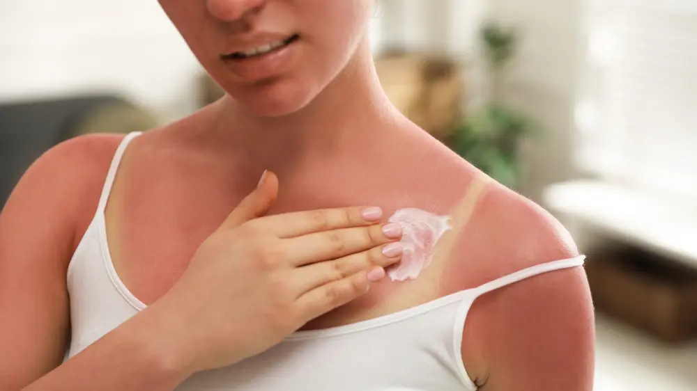 shutterstock_2005979309 opekotine od sunca, krema za opekotine od sunca, opekotine na koži, sunčanje, letojpg-6a424f9a26705.webp