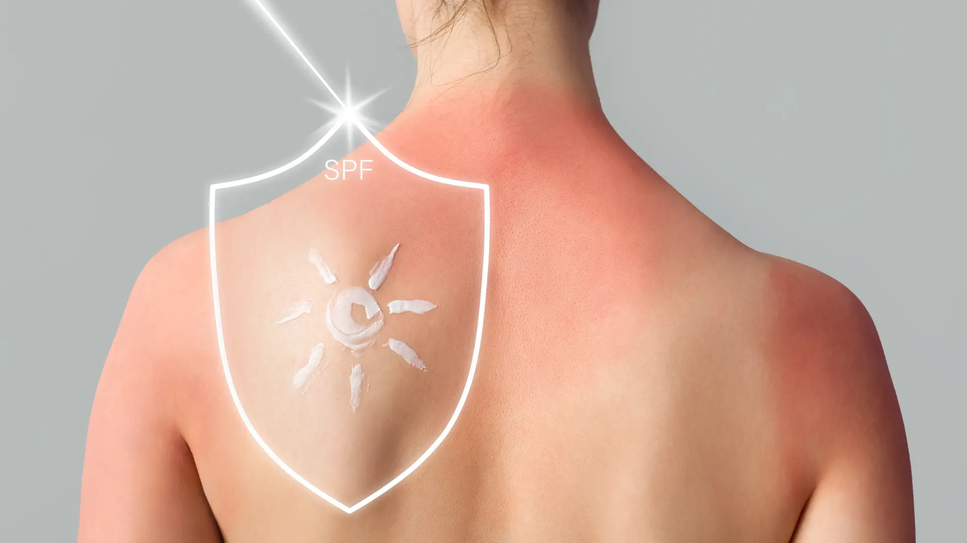 shutterstock_2447789211 sunčanje izgorela koža opekotine SPF krema sunce zaštita od sunca-6a353814d4a6c.webp