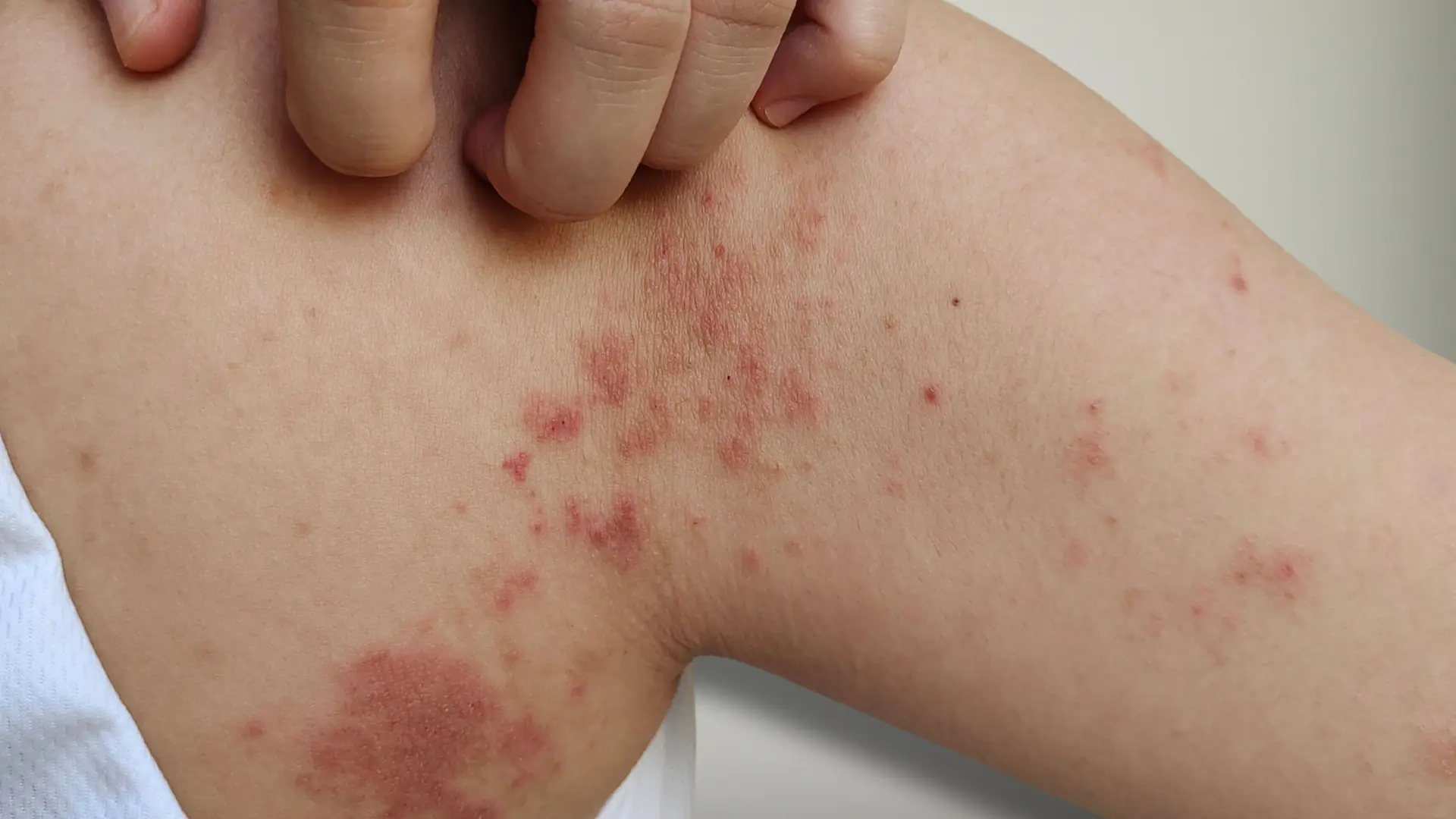 shutterstock_2565697091 Impetigo  svrab infekcija kožno oboljenje koža zaraza crvenilo osip-6a5df7cb3af83.webp