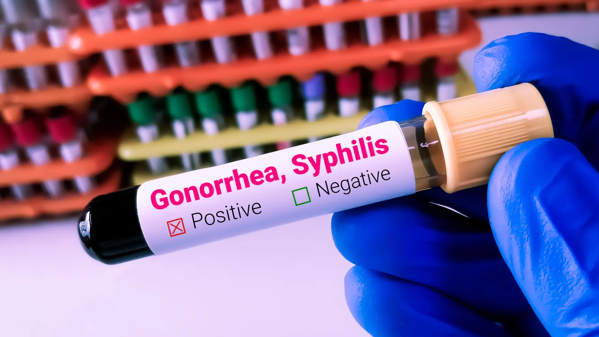 shutterstock_2302064415 sifilis gonoreja polne polno prenosive polnoprenosive bolesti-6aad5df9c57a2.webp