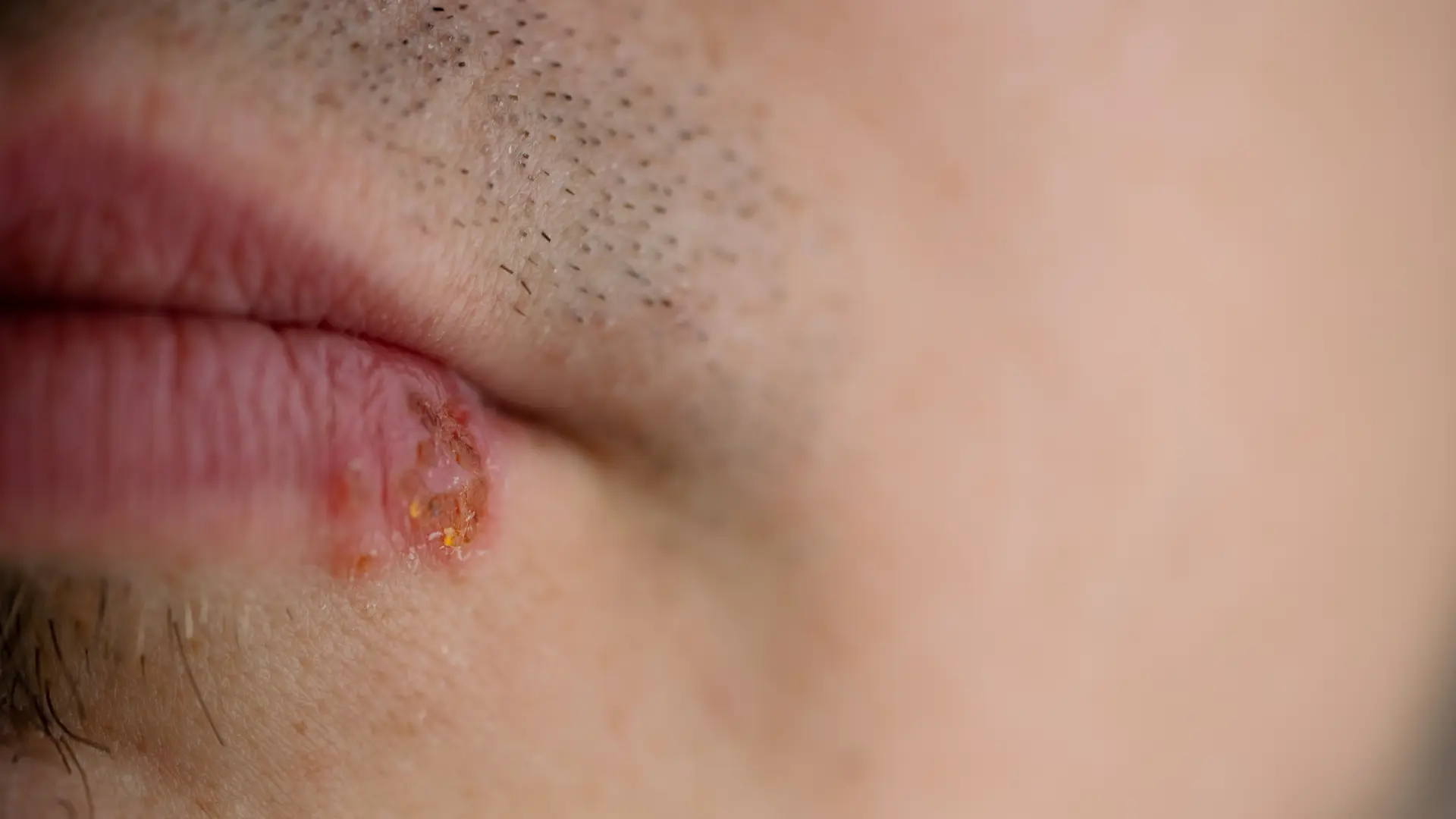 shutterstock_2730666823 herpes groznica na usni usta virus herpesa-6adcce98bb652.webp